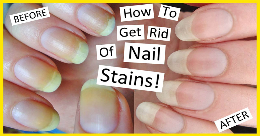 12 Easy Ways To Get Rid Of Yellow Nails At Home - Baggout