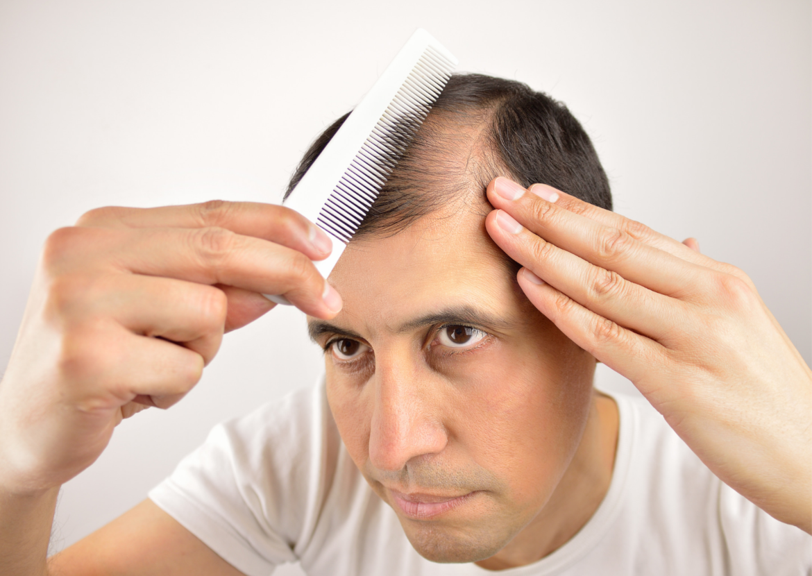 What Are The First Signs Of Balding And How It Can Be Cured Baggout